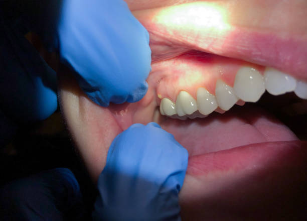 Best Urgent Care for Lost Fillings or Crowns in Quakertown, PA