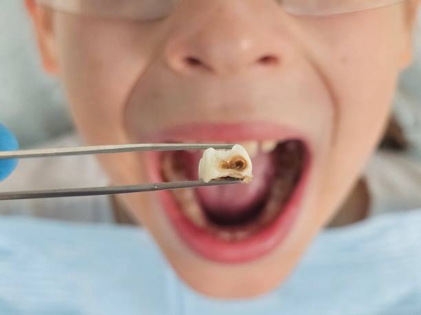 Best Urgent Care for Lost Fillings or Crowns in Quakertown, PA