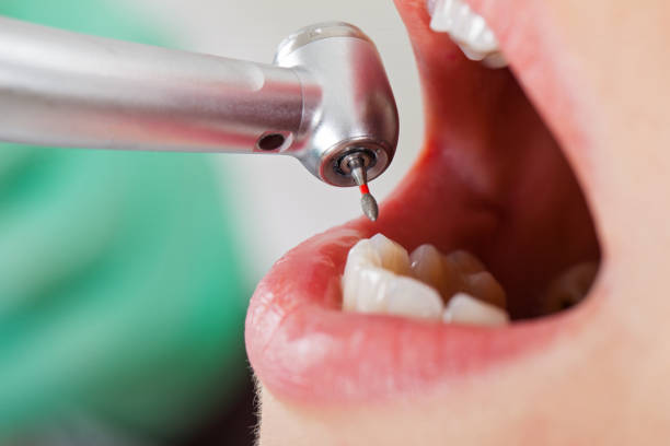 Best Emergency Treatment for Dental Infections or Abscesses in Quakertown, PA
